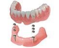 アタッチメント義歯（維持装置）